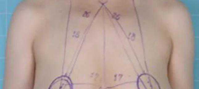 整形美容手术：乳房下垂矫正术