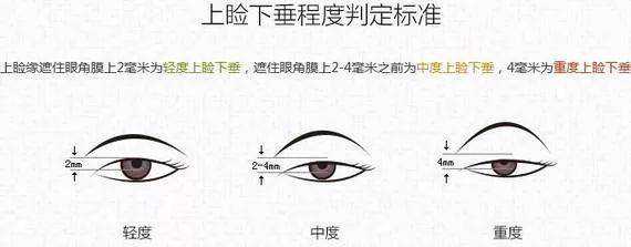 济南海峡美容整形医院分享：双眼皮做了这个才好看！