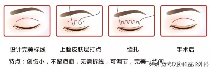 眼部整形知多少？协和整形来解答