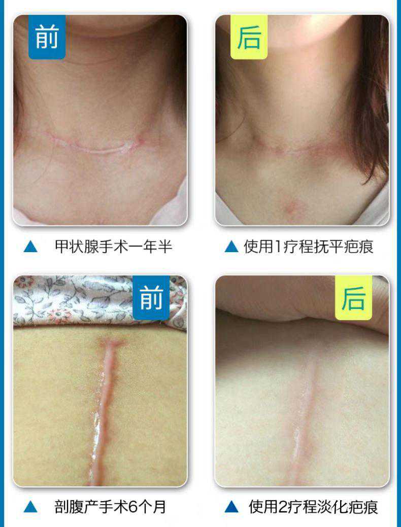 治疗瘢痕，我们是专业的！——济南三院整形美容外科助您祛瘢无忧