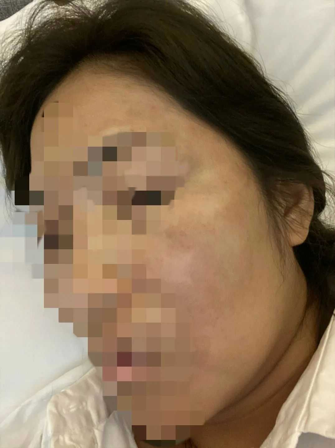 河南整形美容医院又出事了！女子花费20万被整成了花猫脸