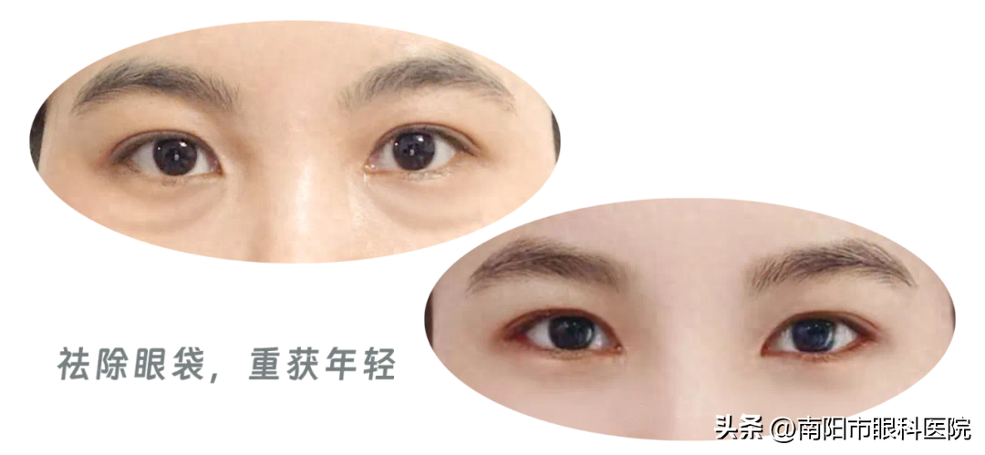 主打年轻的“眼袋祛除术”——美容整形专家涂晓宇为你介绍
