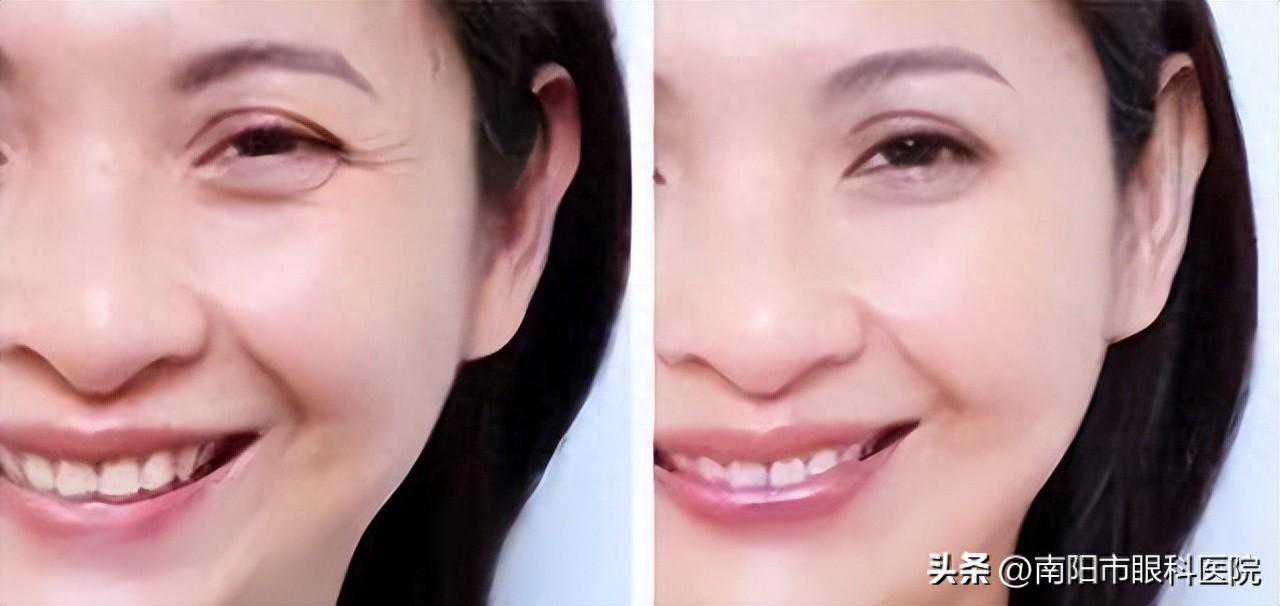 面部除皱总有你想知道的——美容整形主治医师向月为你介绍