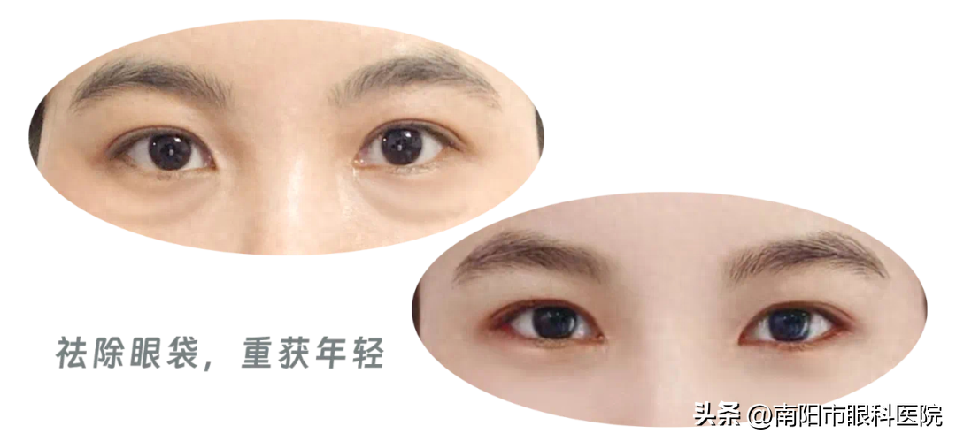 主打年轻的“眼袋祛除术”——美容整形专家涂晓宇为你介绍