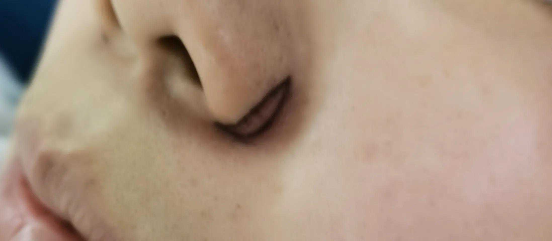 整形美容手术：带你认识鼻翼缩小术