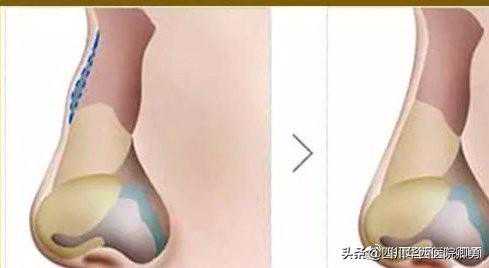 鼻尖整形美容术