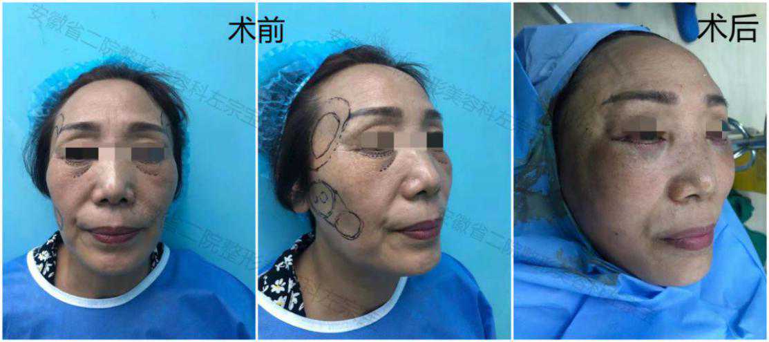 让岁月屈服，把美丽留下——整形美容科开展自体脂肪移植面部年轻化系列手术