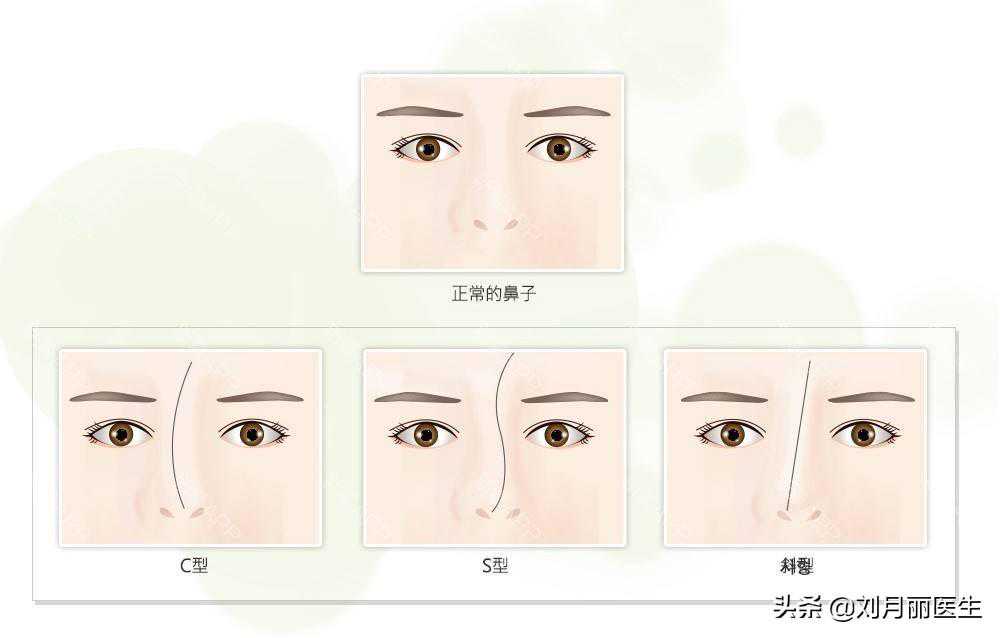 做歪鼻整形手术方法