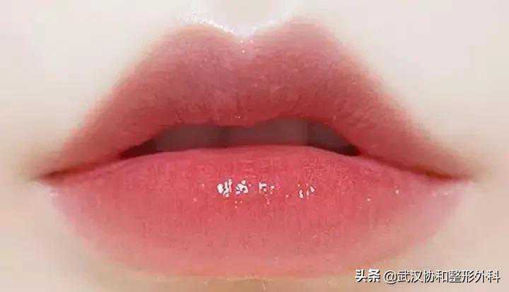 常见的唇部整形都有哪些？