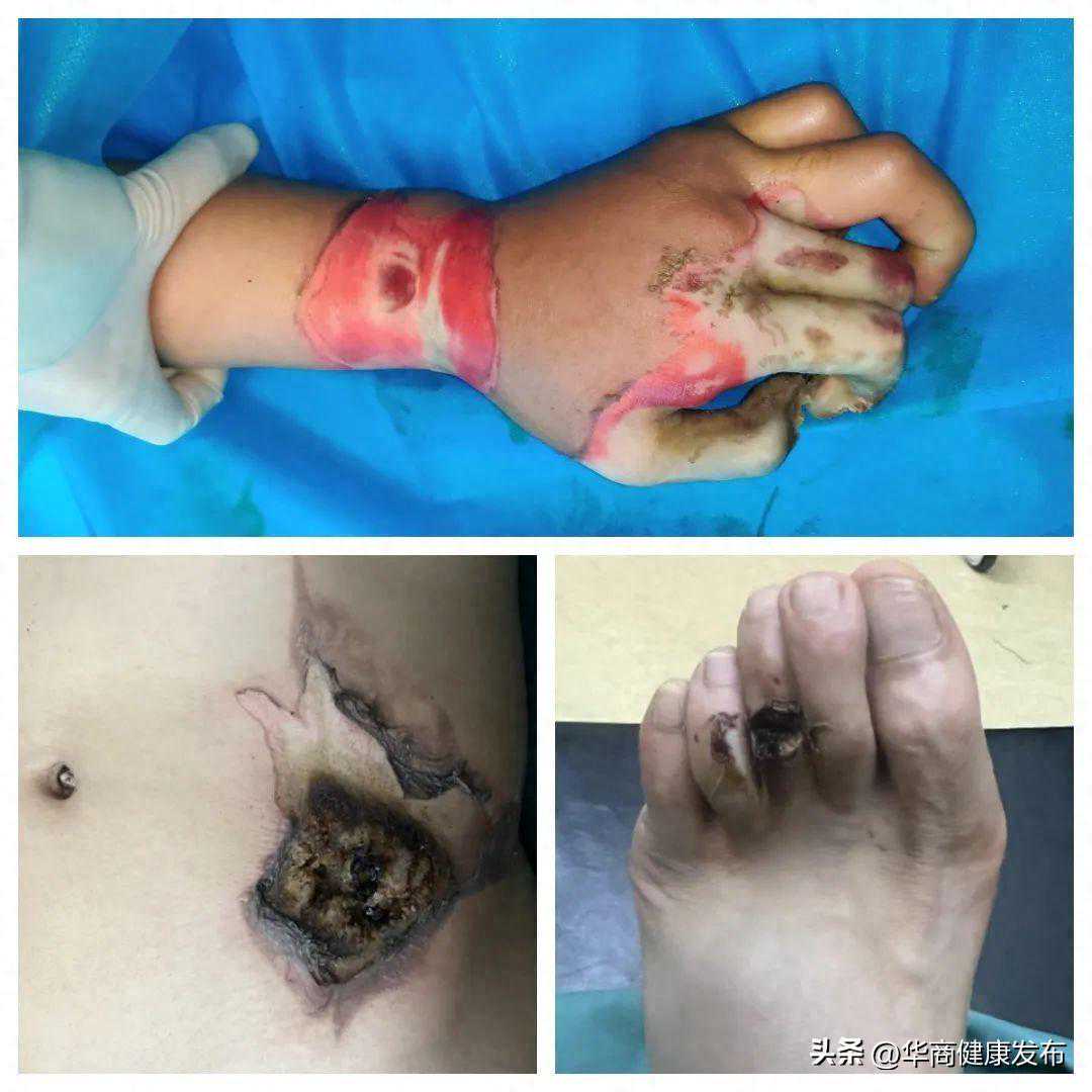 市九院烧伤整形美容科完成“股前外侧皮瓣第2足趾游离移植修复烧伤后腕部深度创面并再造拇指”一例