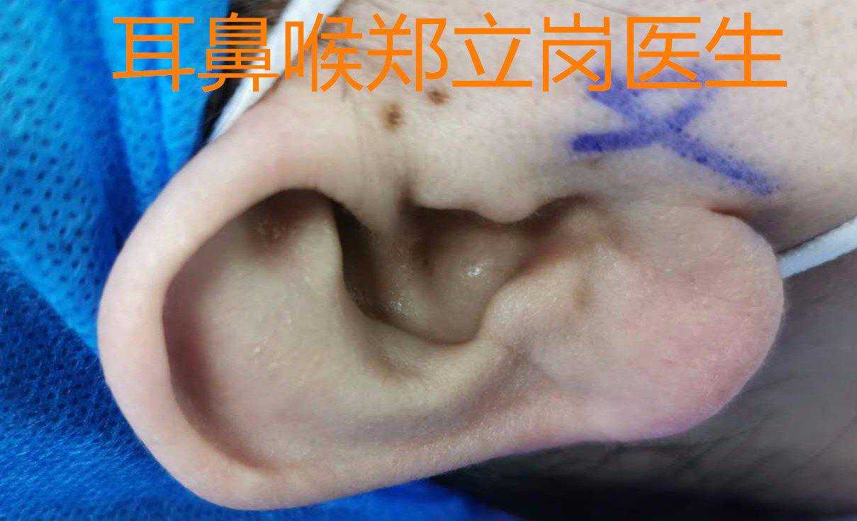 耳垂过大，不好看，整形手术解烦恼