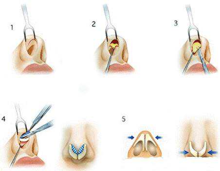 整形手术的十大谣言，你被骗过吗