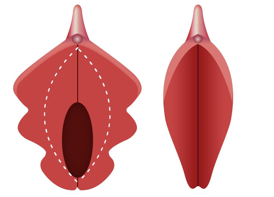 小阴唇整形术，适合什么年纪的人做？