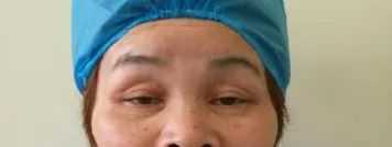 科普——眼整形手术是个什么手术？（多图）