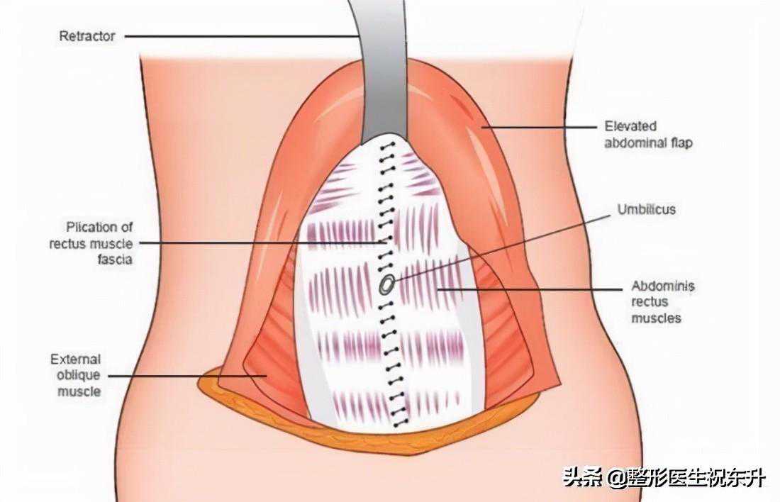 关于“腹壁整形手术”，我来公开手术全过程