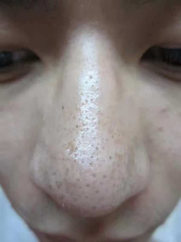 有了黑头别再挤，美容院不外传去黑头3部曲，美容师都在用