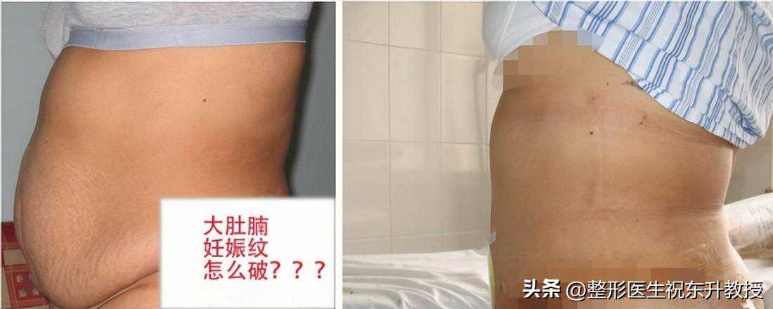 公开“腹壁整形”的手术细节，看着疼，效果好呀