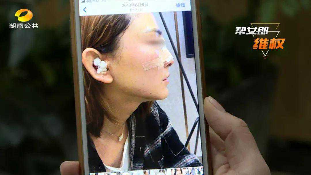 可怕！女子想要“高鼻梁”，整形完发现鼻头“不见了”？！