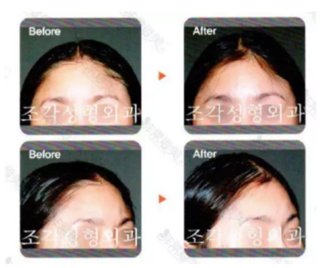 私处整形、小腿肌肉阻断 | 别为了美命都不要了