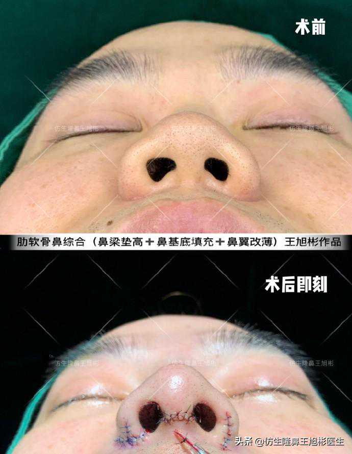 外切缩鼻翼会留疤吗？鼻翼整形都包括哪些项目