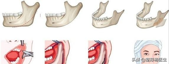 我脸太大了！需要做整形削骨！请问有没有后遗症？
