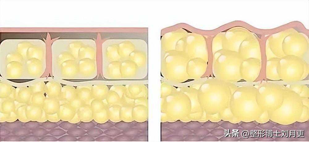 深圳军科整形医院：脂肪移植填充隆胸有哪些风险？