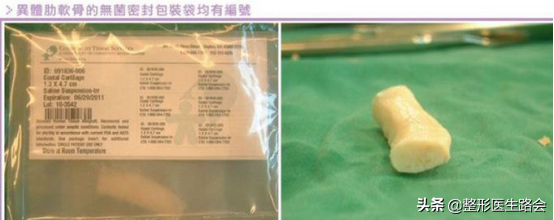 用男朋友的肋软骨隆鼻行不行？异体骨鼻整形靠谱吗？