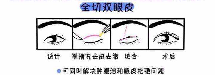 济南海峡整形科普：关于双眼皮修复，那些你不知道的事