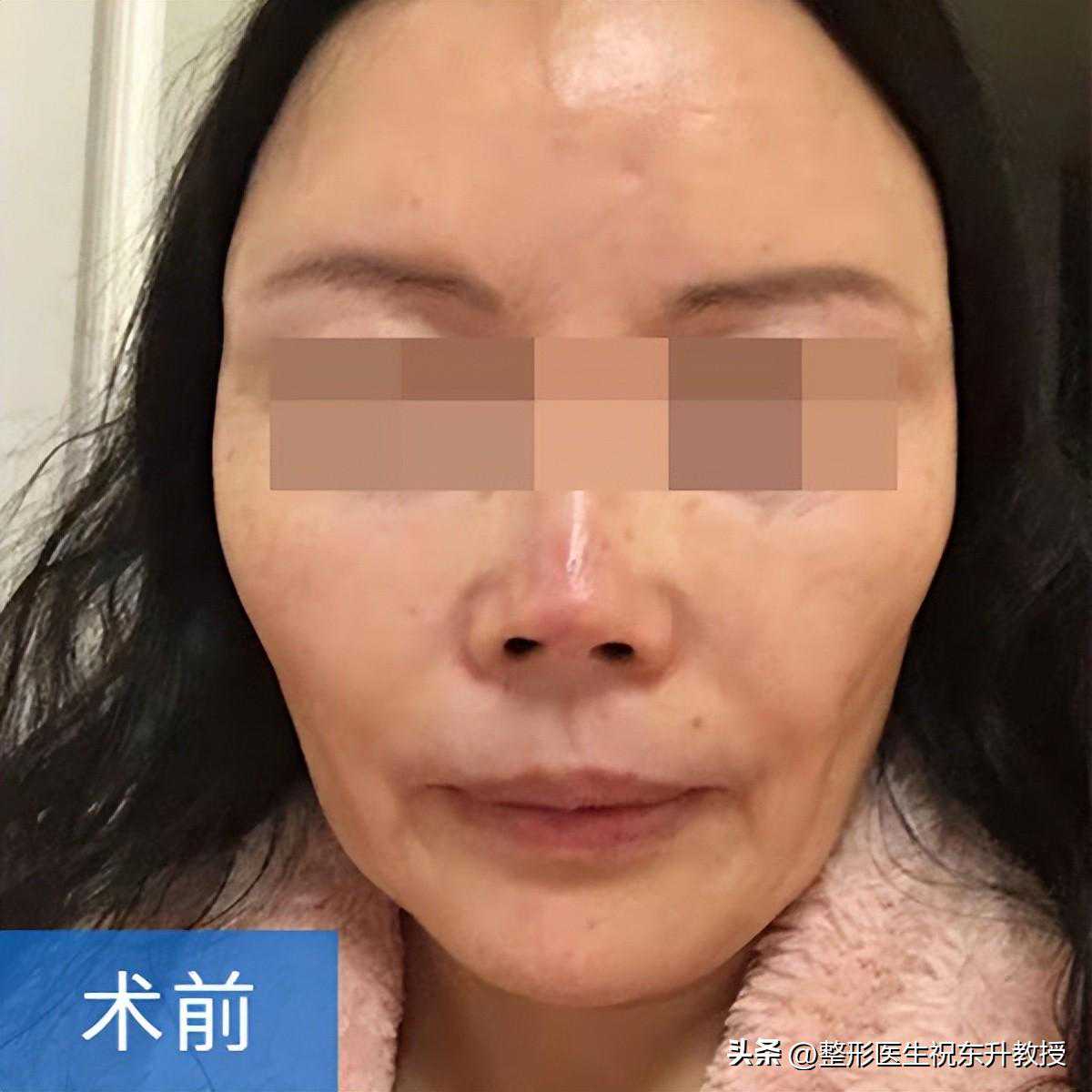 1次线雕，2次鼻整形，直言“后悔”！“拉皮”6个月重塑年轻容貌