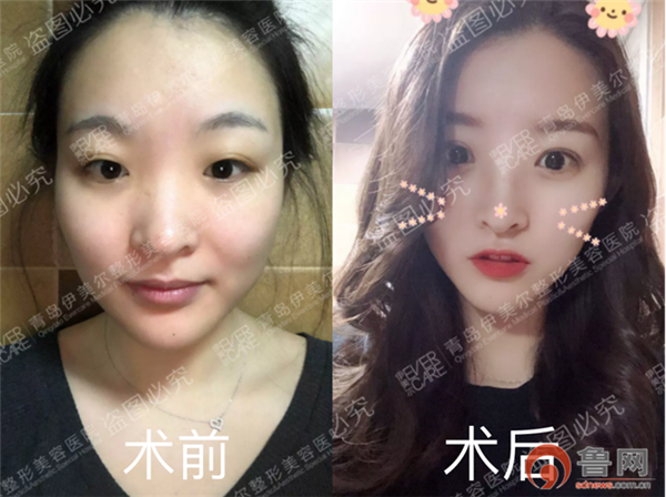 我在青岛伊美尔做的5S双眼皮+开眼角 整形对我改变好大