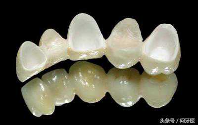 揭秘：美容冠矫正牙齿，不要再上当了！