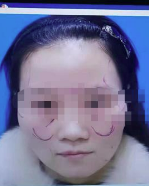 晨意帮忙｜女子因老公出轨想通过整形挽回，结果术后变老了？