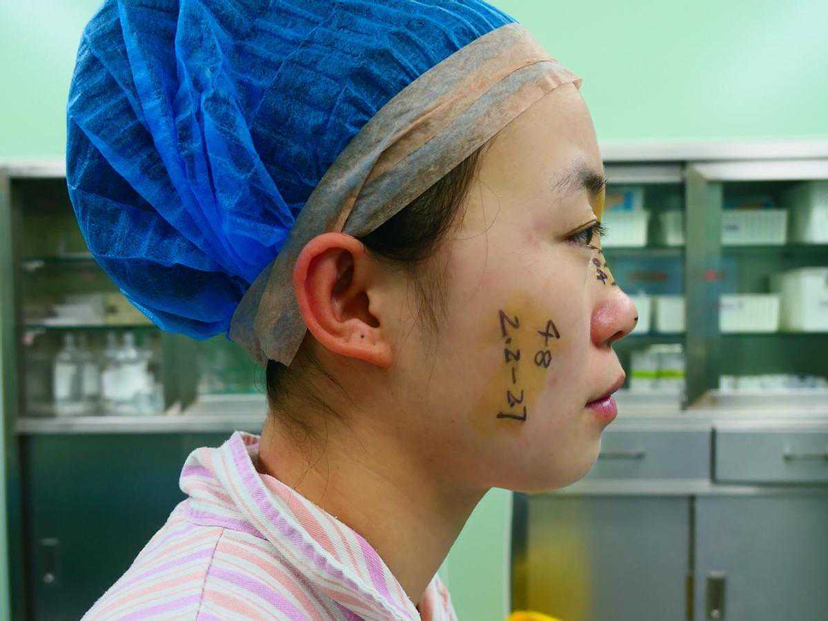 25岁天津小姑娘，瞒着老公来北京整形，即刻变成了“大脸娃娃”