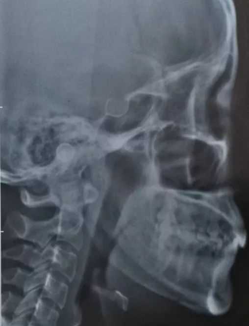 四千块割的双眼皮，再花四万缝回来 | 整形花过的最大一笔钱