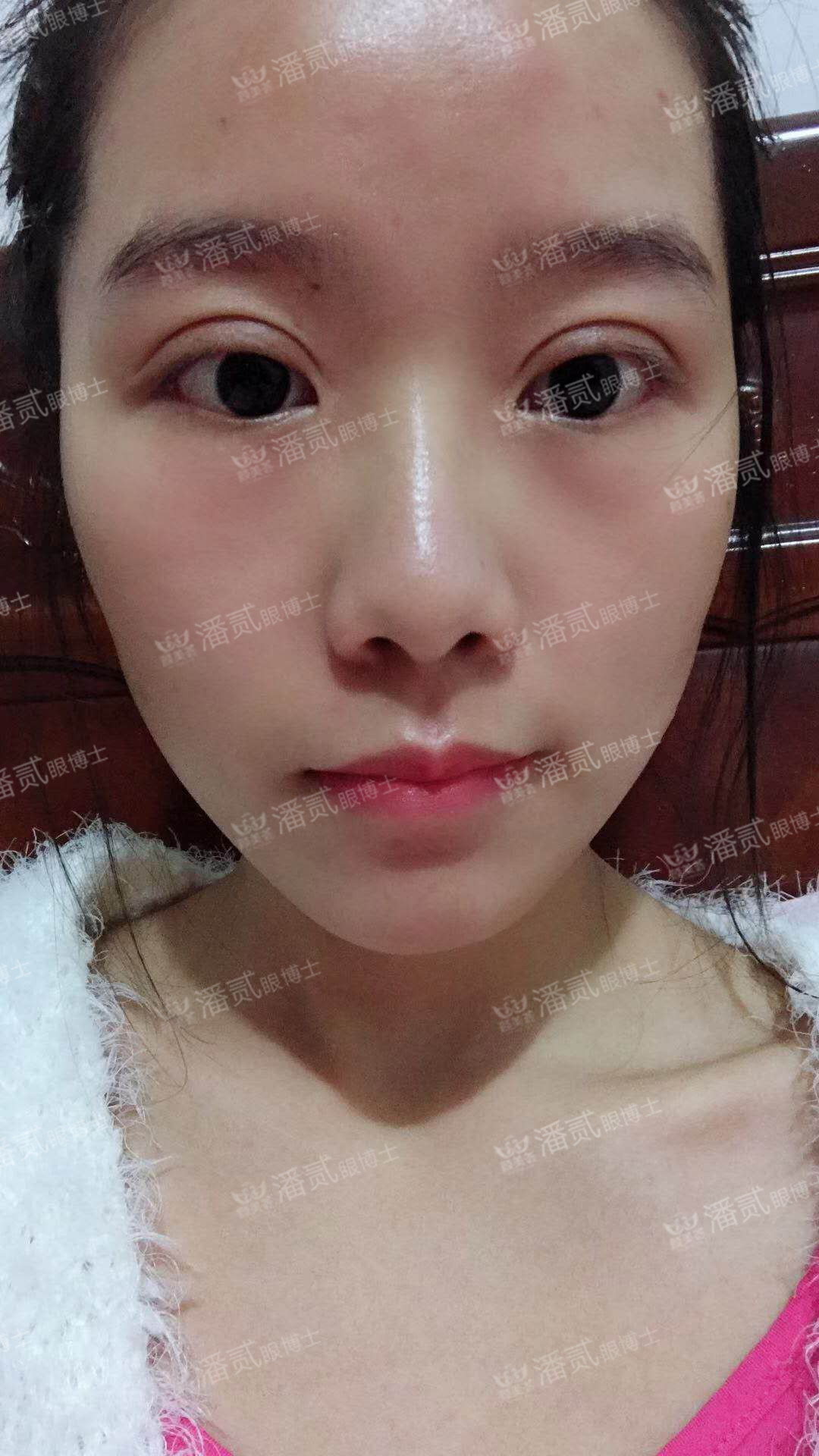 双眼皮整形：双眼皮失败修复需要填脂肪的看过来！恢复过程参考