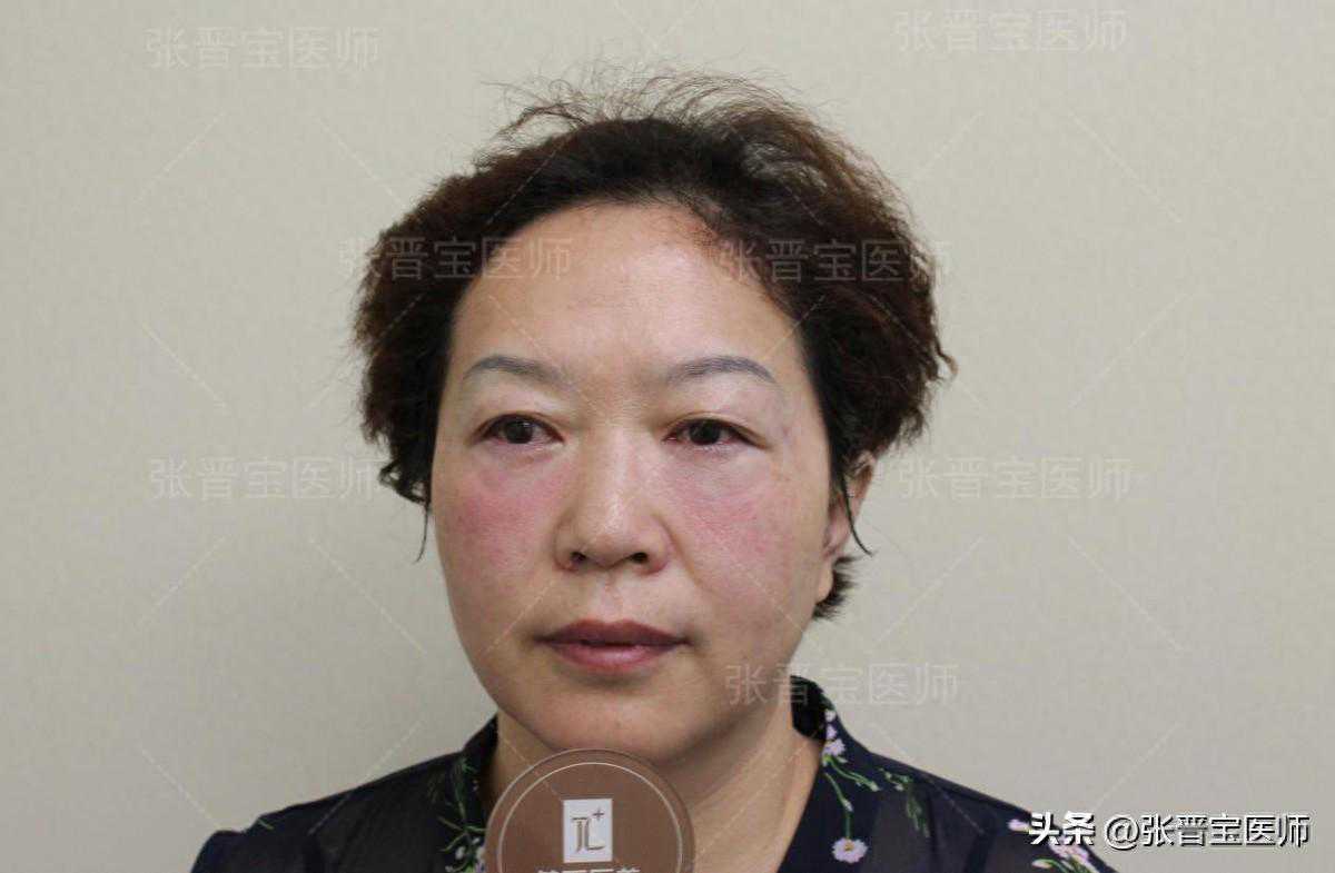 50岁去上海整形，30分钟轻松搞定眼袋泪沟，术后7天惊艳所有人