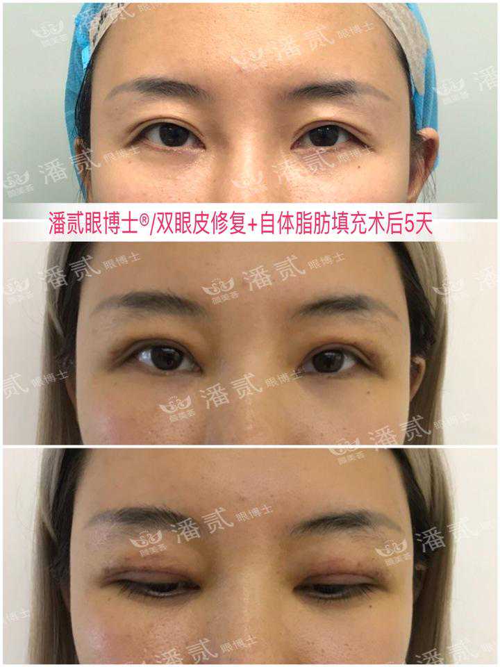 割双眼皮后有人睫毛变长，有人却变短？眼部整形压睫毛有何学问？