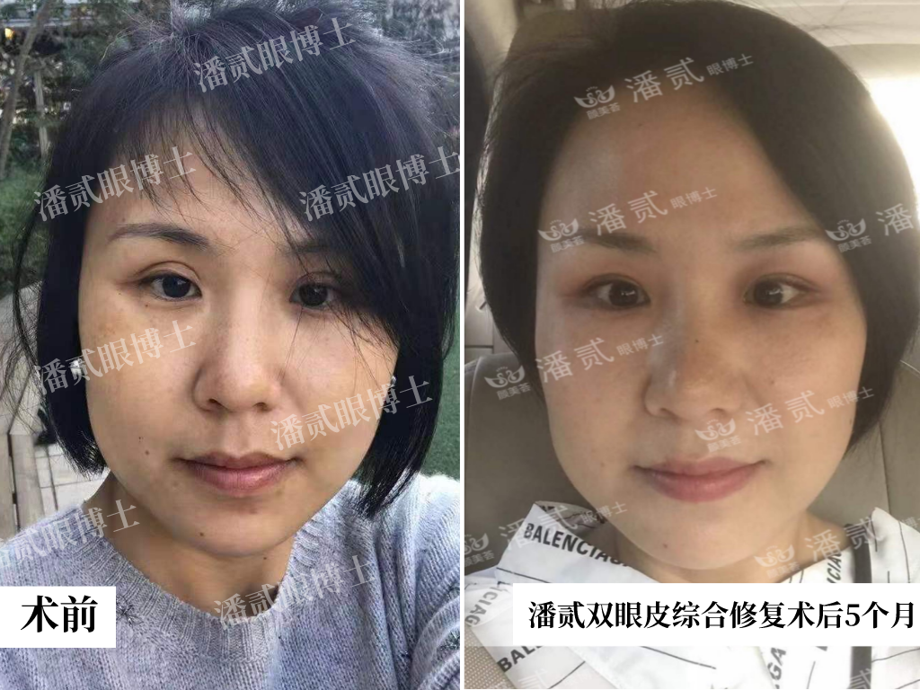 东莞美女害怕整形了！连做两次整容都失败，割出了个宽深的双眼皮