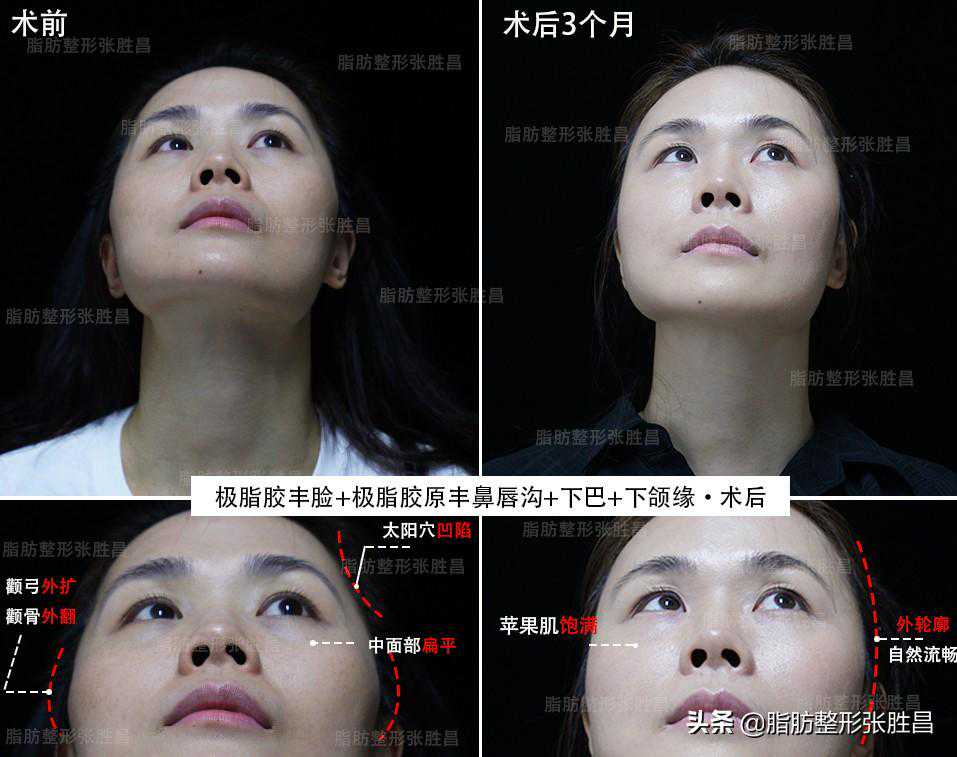 41岁因为菱形脸决定整形？太阳穴凹陷、颧骨突出的烦恼也该解决了