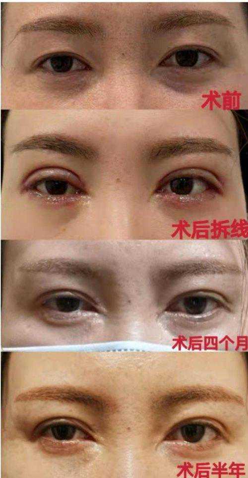 「315」宝鸡女子西安眼部整形后出现大小眼、疤痕脸，实名举报医美机构