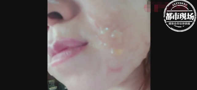 女子体验医美热玛吉，不料美容变“毁容”：“治疗费要十几万”