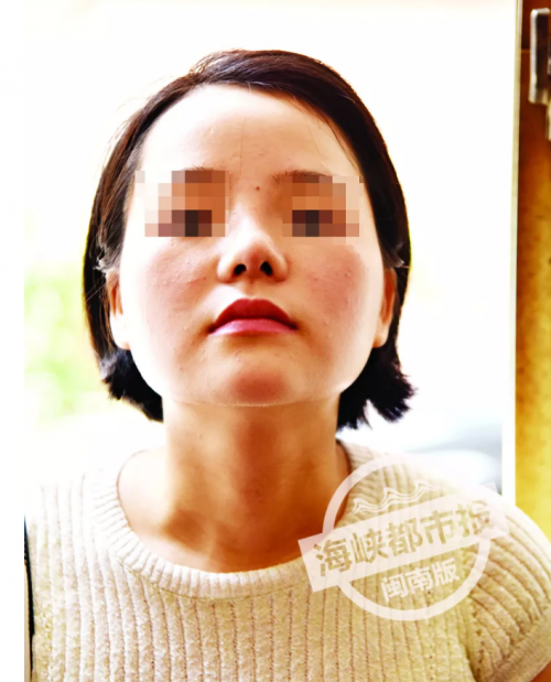 女子怒诉泉州东大医疗美容：花4.4万整容 鼻子歪成这样