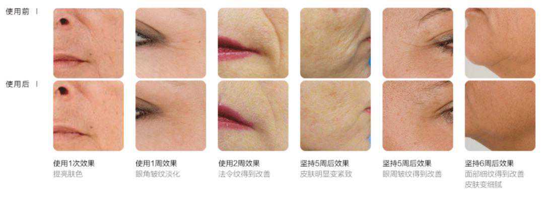 用它竟能年轻十岁！以色列进口美容仪，让皱纹越来越淡