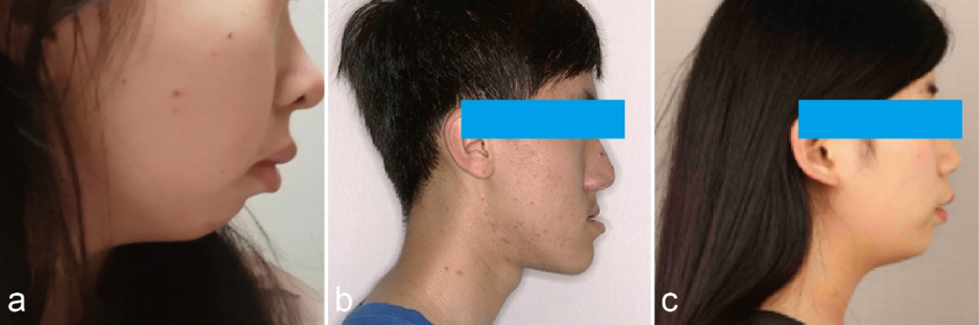 告别颌骨畸形——青岛市口腔医院开设正颌美容专病门诊