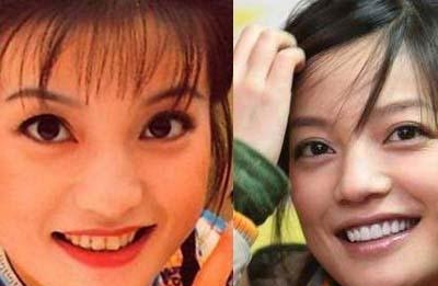 刘涛做了三次“美容冠”！这是拥有一口美牙的最佳方法吗？