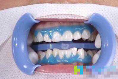 牙齿美容：快速美白牙齿的方法，皓齿、冷光和炫彩有什么区别？