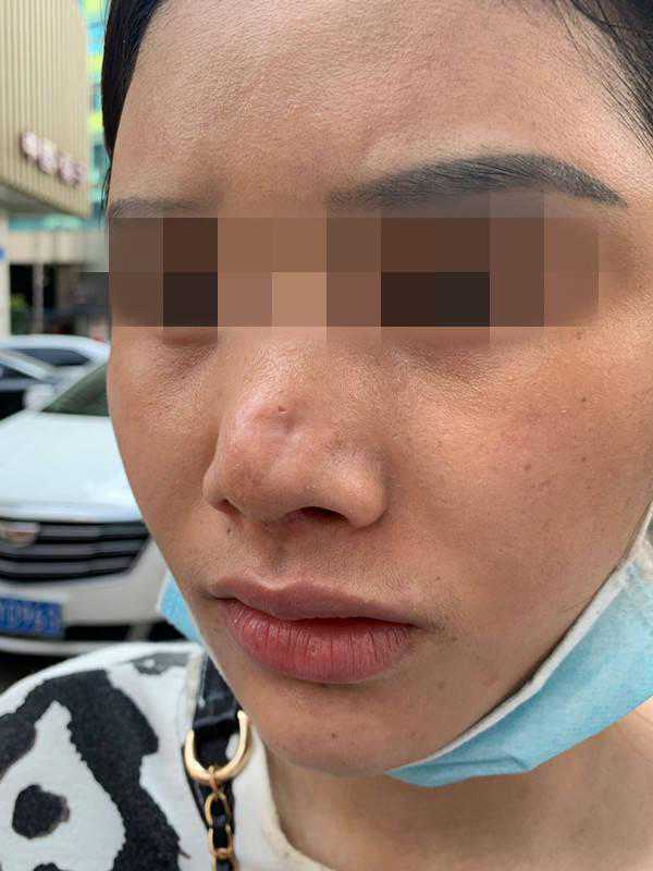 美容还是毁容？一女子贷款5.5万元修复隆鼻，结果鼻头出现凹陷