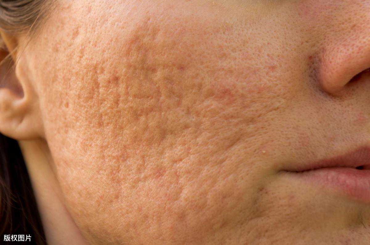 祛痘坑有这些先进的方法，不要盲目乱做美容项目，先懂这些知识