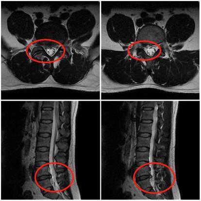 区内首例！宝山医院成功开展UBE下纤维环缝合技术