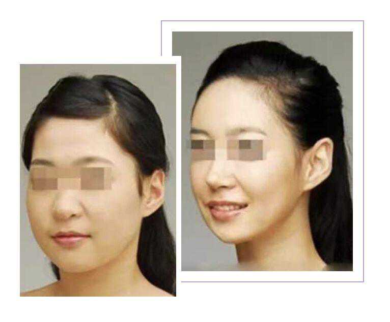 关于瘦脸针，你还应该知道的事儿